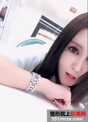 吸脂瘦脸10