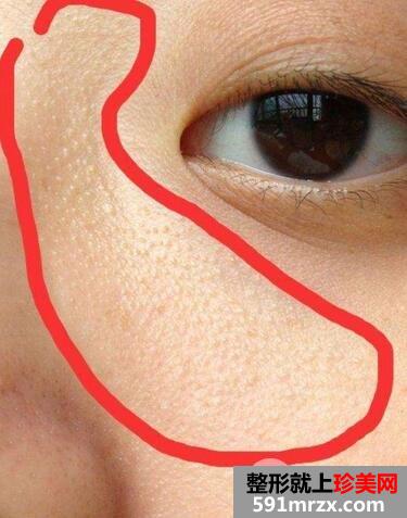 汗管瘤的治疗方法2