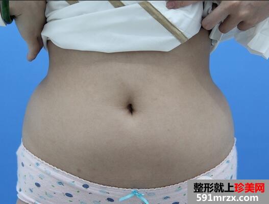 360溶脂减肥1