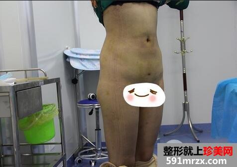 360溶脂减肥8