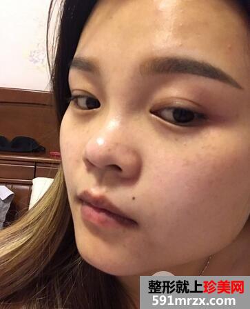 怎样使鼻子变挺2