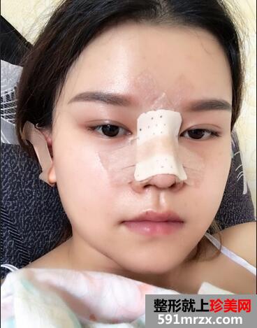怎样使鼻子变挺3