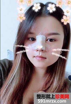 怎样使鼻子变挺4