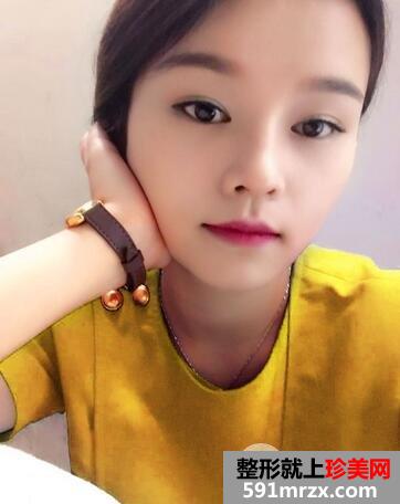 怎样使鼻子变挺7