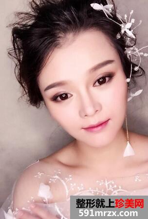 怎样使鼻子变挺10