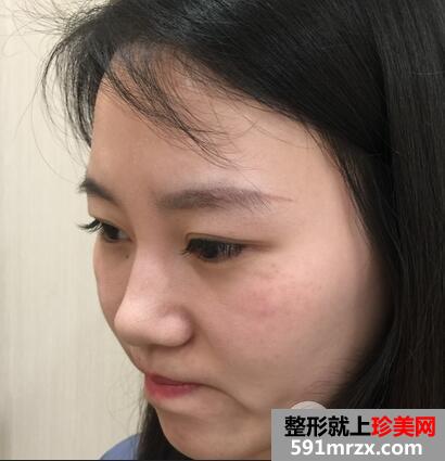 彩光嫩肤安全吗1