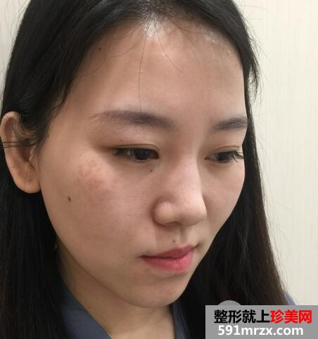 彩光嫩肤安全吗2