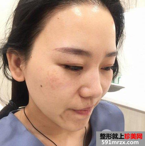 彩光嫩肤安全吗3