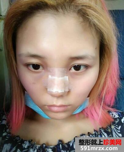 垫高鼻子3