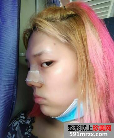 垫高鼻子4