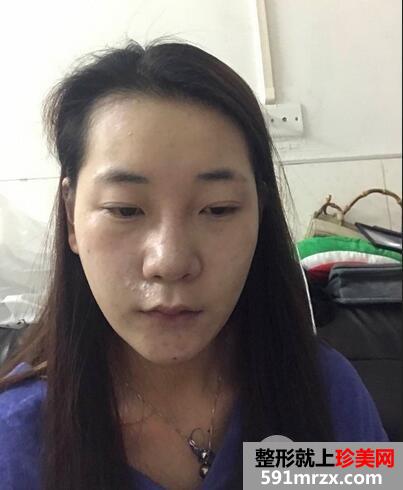 膨体材料隆鼻1