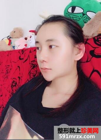 膨体材料隆鼻2