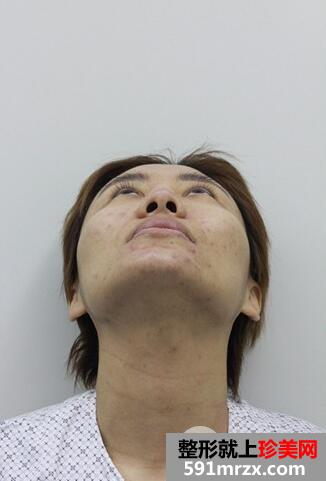 韩式立体隆鼻术2
