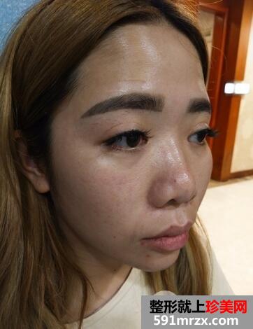 隆鼻失败修复1