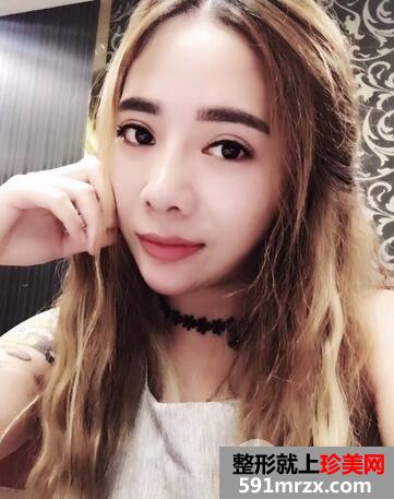 隆鼻失败修复8