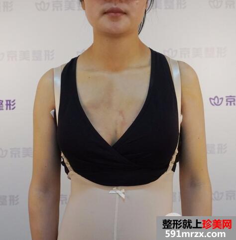 隆胸假体取出7