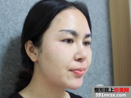 瘦脸针3