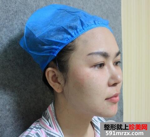 瘦脸针5