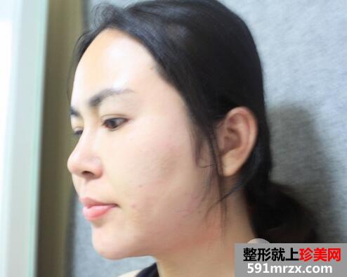瘦脸针6