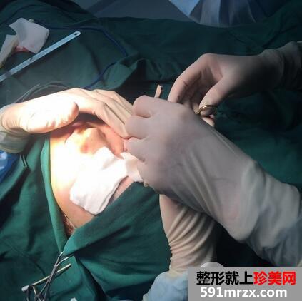 假体隆胸2