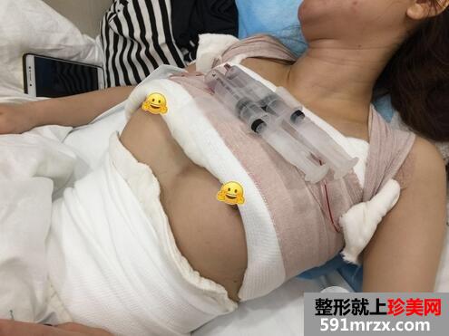 假体隆胸3