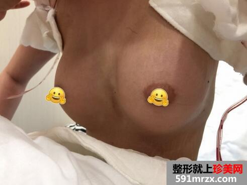 假体隆胸5