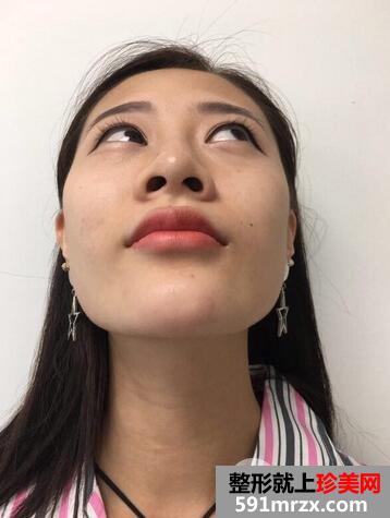 鼻型矫正1