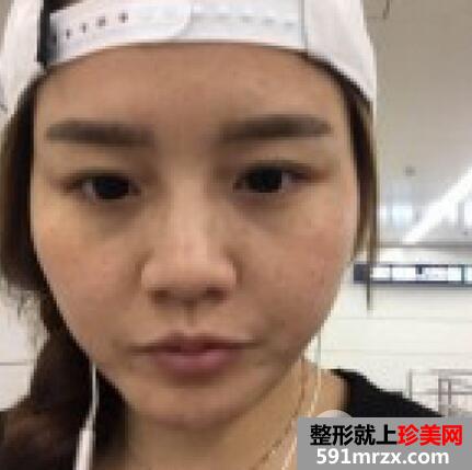 自体脂肪隆鼻2