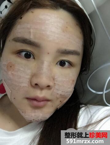 自体脂肪隆鼻5
