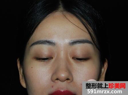 上睑下垂1