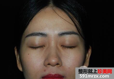 上睑下垂2