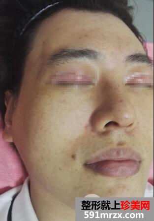 激光去雀斑2