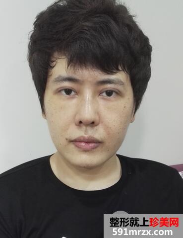 激光去雀斑4