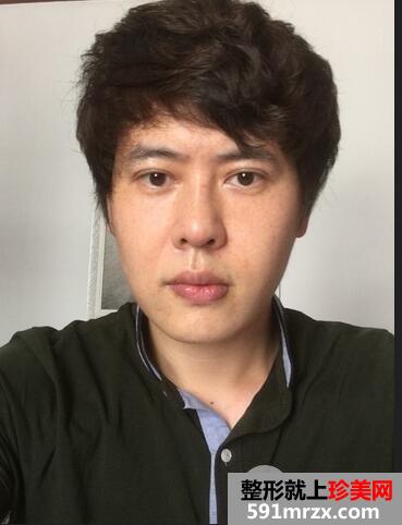 激光去雀斑7