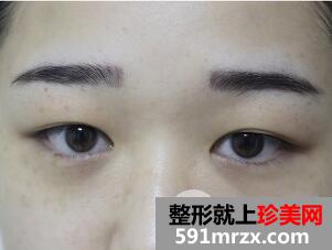 全切双眼皮1