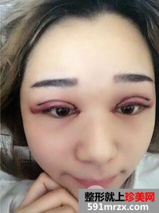 全切双眼皮2
