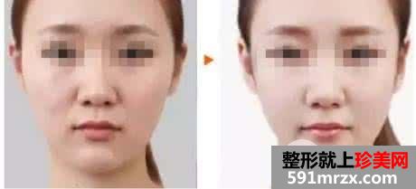 面部整形丰太阳穴有什么风险吗?