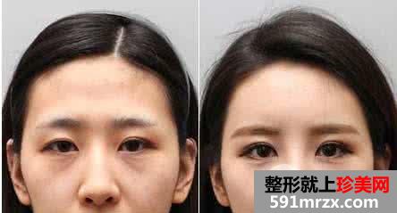 面部美容填充泪沟用自体脂肪效果好不好?