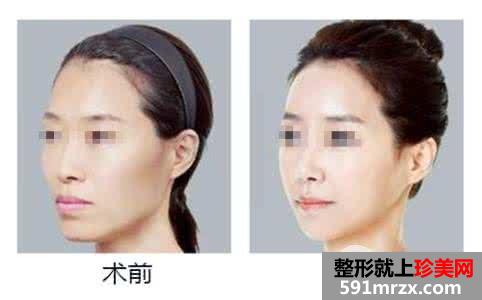 面部轮廓塑造自体脂肪丰太阳穴效果是永久的吗