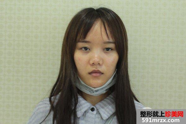 鼻综合整形真实恢复期图片，打造日系萌妹