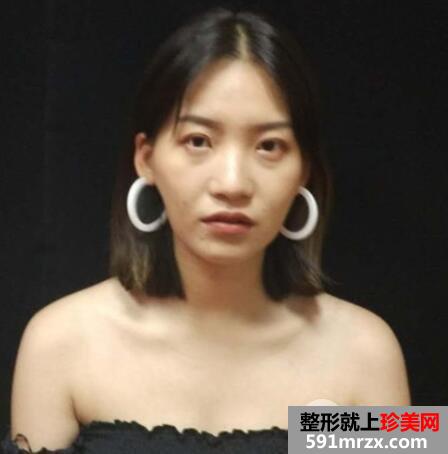隆鼻整形日记|附上恢复过程介绍以及对比图