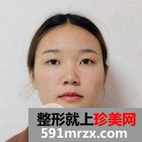 成都艾米丽医疗美容鼻综合要多少钱|硅胶隆鼻+耳软骨垫鼻尖+鼻中隔