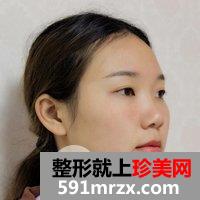 成都艾米丽医疗美容鼻综合要多少钱|硅胶隆鼻+耳软骨垫鼻尖+鼻中隔