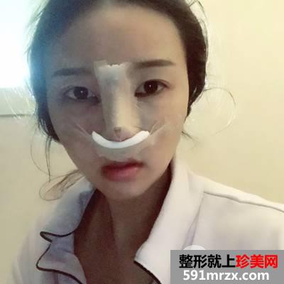 成都艾米丽医疗美容鼻综合要多少钱|硅胶隆鼻+耳软骨垫鼻尖+鼻中隔