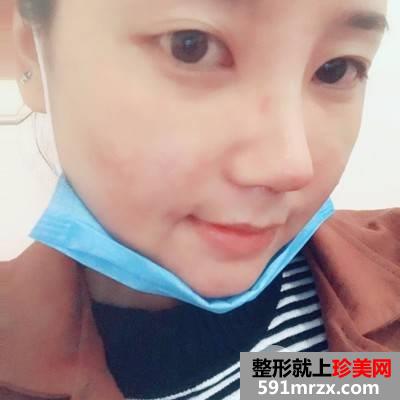 成都艾米丽医疗美容鼻综合要多少钱|硅胶隆鼻+耳软骨垫鼻尖+鼻中隔