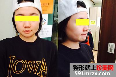 磨颧骨前后对比图