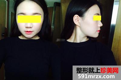 磨颧骨前后对比图