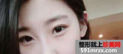 在北京做生物焊接双眼皮 期待效果哟