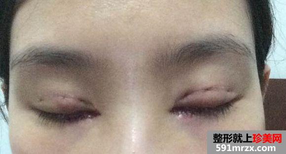 在北京做生物焊接双眼皮 期待效果哟