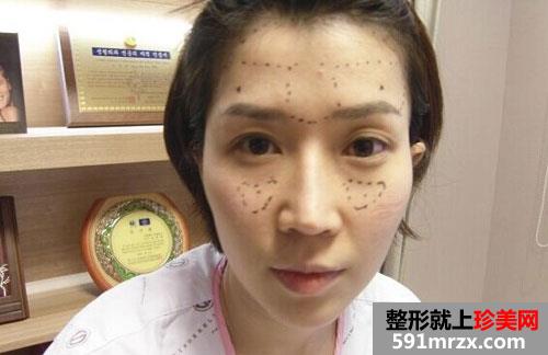 自体脂肪填充额头+硅胶假体隆鼻手术前后效果对比图和恢复过程